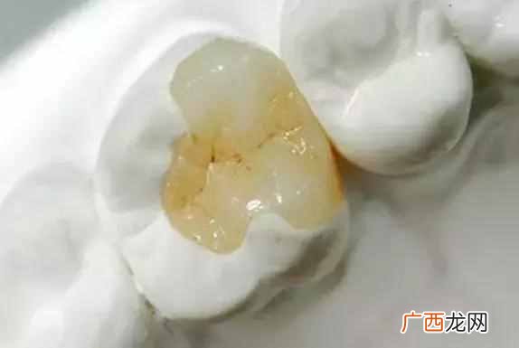 蛀牙老人补牙用什么材料好？补牙后一般能用几