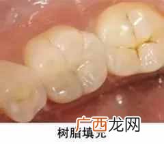 蛀牙老人补牙用什么材料好？补牙后一般能用几