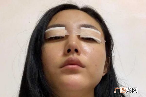 肿眼泡能割双眼皮吗及割双眼皮的注意事项