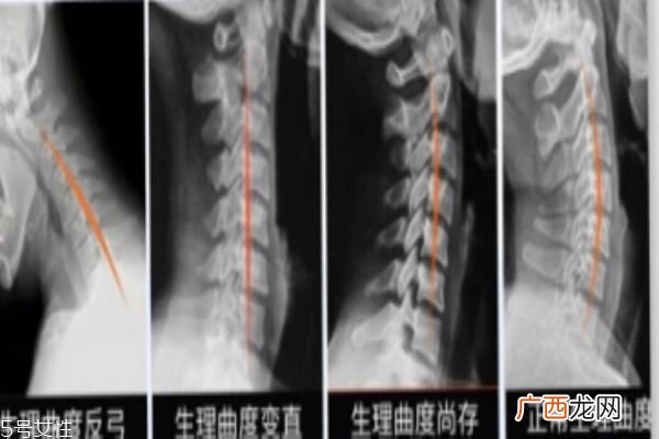 skg颈椎按摩仪怎么使用要配合按摩操一起