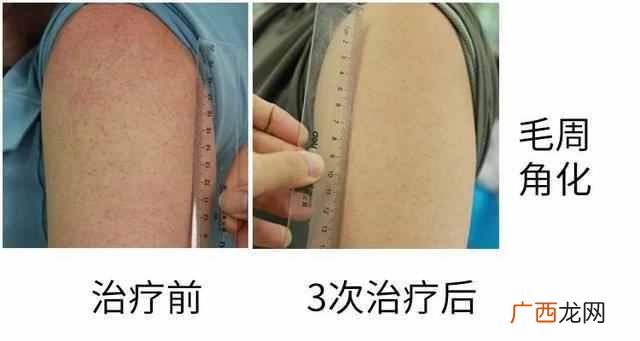 果酸换肤是什么原理（大揭秘：果酸换肤适合什