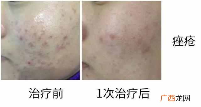 果酸换肤是什么原理（大揭秘：果酸换肤适合什