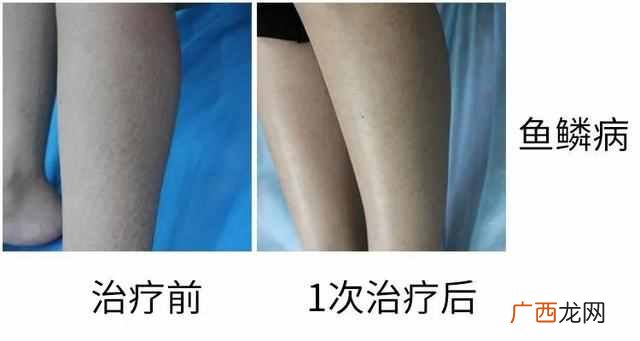 果酸换肤是什么原理（大揭秘：果酸换肤适合什
