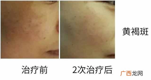 果酸换肤是什么原理（大揭秘：果酸换肤适合什