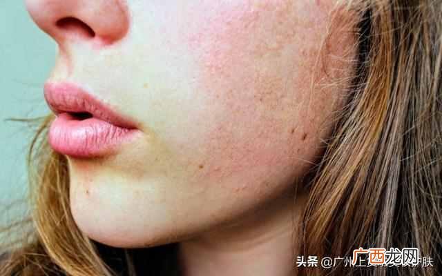 修复皮肤屏障是什么意思(皮肤科医生告诉你如