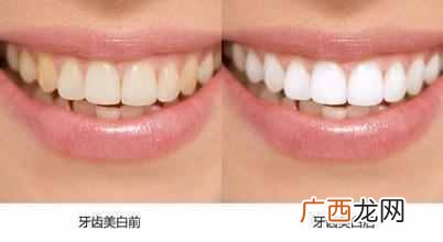 市面上男生用什么牙膏美白效果好（教你在家自