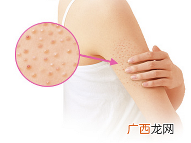 好用且去鸡皮肤的身体乳推荐 有鸡皮肤要注意