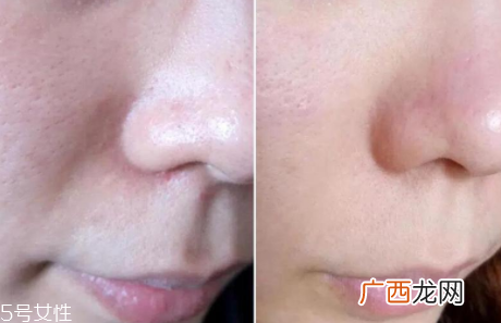 aesop伊索祛痘凝胶怎么样？一晚还你平滑肌肤