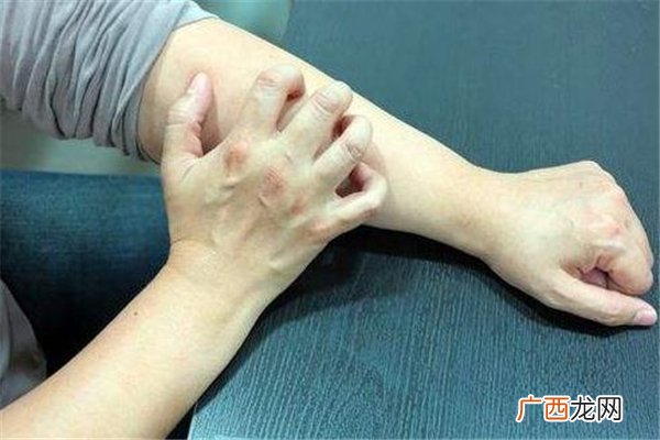 什么是冬季痒冬季痒预防之道