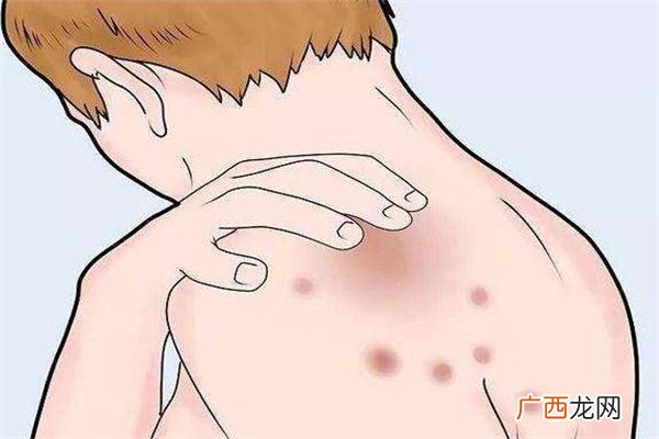什么是玫瑰糠疹如何鉴定玫瑰糠疹