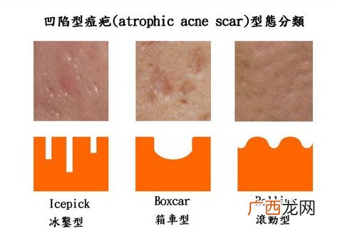 青春痘凹陷性疤痕修复方法