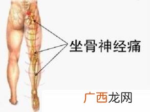 坐骨神经痛怎么治疗是怎么引起的