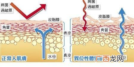异位性皮炎用什么药保湿