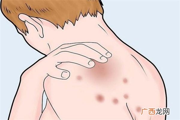 冬季湿疹怎么办预防才是重点