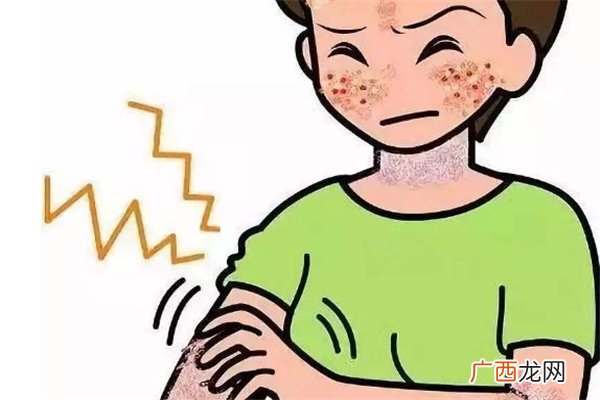 缺脂性皮炎症状与保养治疗