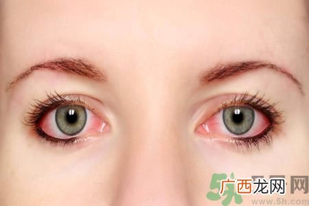 流感咳嗽导致眼睛出血怎么办?眼睛出血严重吗?
