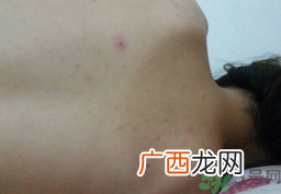为什么背后老是长痘痘?背后总是长痘痘怎么办?