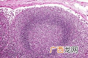 什么是前哨淋巴结早期乳癌精确分期并发症减少