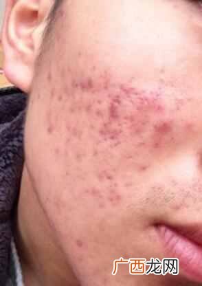 怎么快速去除痘印小妙招（牙膏如何一夜快速祛