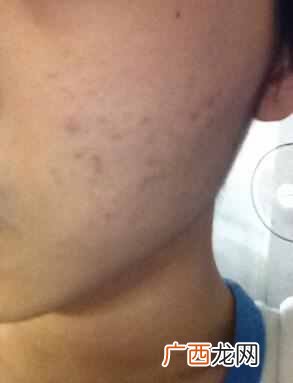 怎么快速去除痘印小妙招（牙膏如何一夜快速祛