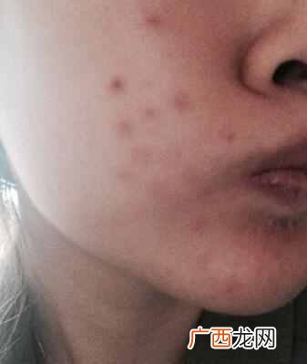 怎么快速去除痘印小妙招（牙膏如何一夜快速祛