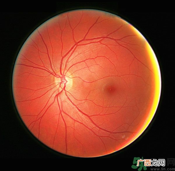 得了红眼病可以吃鸡蛋吗红眼病能不能吃鸡蛋