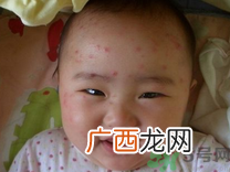 12岁男孩身上长很多红点怎么回事?长了水痘怎么办?