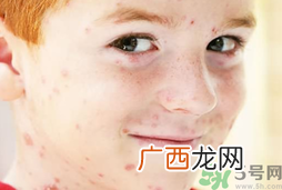 孩子得了水痘全身很痒怎么办?缓解水痘瘙痒妙招