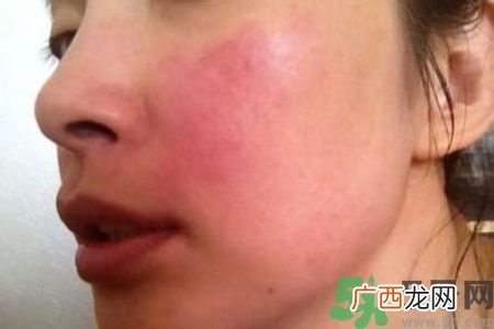 我15岁皮肤过敏怎么办?15岁皮肤过敏能自愈吗?
