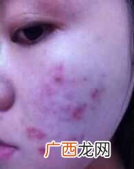 多年的痤疮怎么去除（长痘痘几年了皮肤很差怎