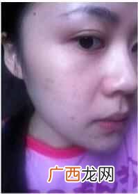 多年的痤疮怎么去除（长痘痘几年了皮肤很差怎