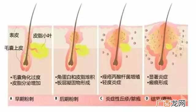 鼻子凹坑最难治 鼻子有痘坑怎么办