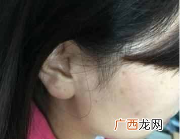 怎么去青春痘最快最有效的方法是什么（挤出世