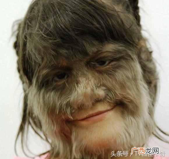 脸部的毛能脱吗 少女脸上长毛怎么办