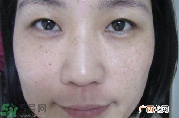 肝斑是肝有问题吗?肝斑怎么调理简单方法