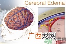 癫痫的发病因素？癫痫的并发症有哪些？