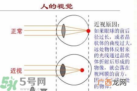 近视眼的发病因素？近视眼的并发症有哪些？
