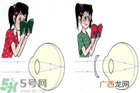 近视眼的发病因素？近视眼的并发症有哪些？