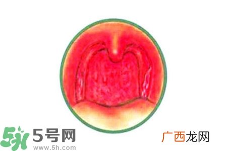 慢性咽炎的治疗方法？慢性咽炎的药物治疗？