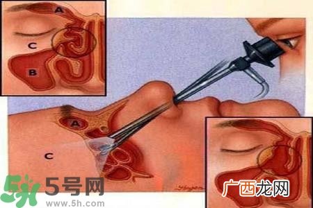 鼻窦炎的高发人群？如何预防鼻窦炎？