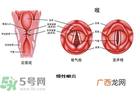慢性咽炎是什么？慢性咽炎的症状有哪些？