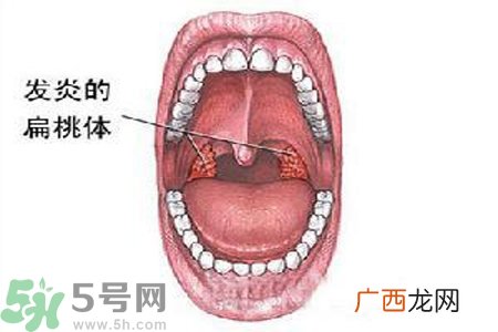 慢性咽炎是什么？慢性咽炎的症状有哪些？