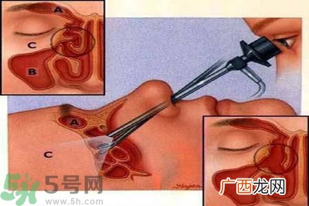 鼻窦炎的护理措施？鼻窦炎的饮食护理？