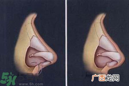 鼻窦炎的护理措施？鼻窦炎的饮食护理？