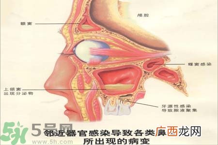 鼻窦炎是什么？鼻窦炎的症状有哪些？