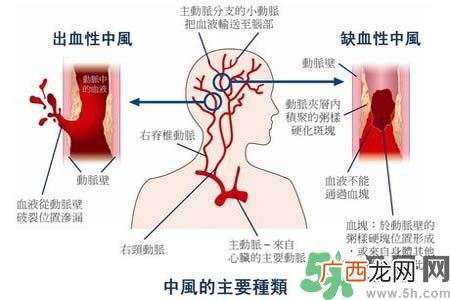 脑中风的发病因素？脑中风的并发症有哪些？