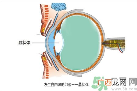 白内障的护理措施是什么？白内障的饮食护理有哪些？