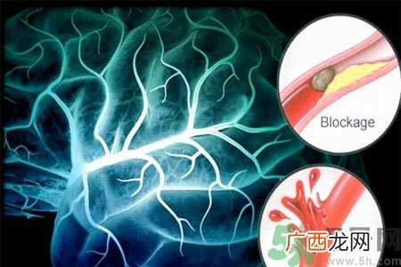 脑出血的发病因素是什么？脑出血的并发症有哪些？