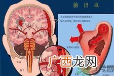脑出血的发病因素是什么？脑出血的并发症有哪些？