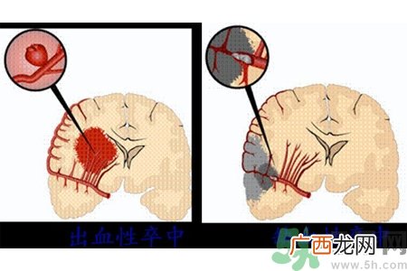 脑出血的发病因素是什么？脑出血的并发症有哪些？